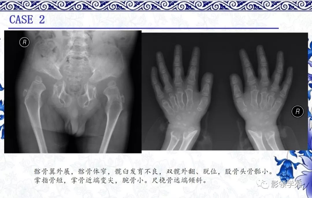 影像PPT - 【PPT】常见骨软骨发育异常的X线表现-43 影像PPT - 【PPT】常见骨软骨发育异常的X线表现-43
