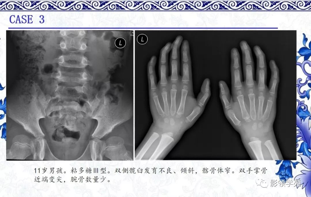 影像PPT - 【PPT】常见骨软骨发育异常的X线表现-44 影像PPT - 【PPT】常见骨软骨发育异常的X线表现-44