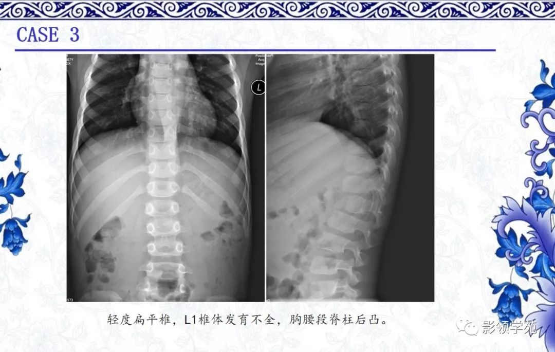 影像PPT - 【PPT】常见骨软骨发育异常的X线表现-45 影像PPT - 【PPT】常见骨软骨发育异常的X线表现-45