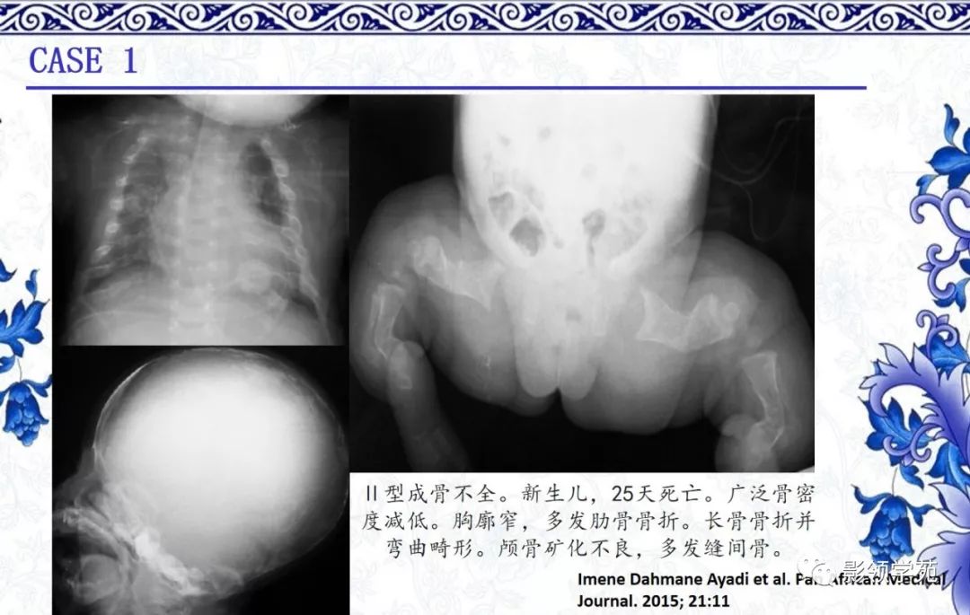 影像PPT - 【PPT】常见骨软骨发育异常的X线表现-48 影像PPT - 【PPT】常见骨软骨发育异常的X线表现-48