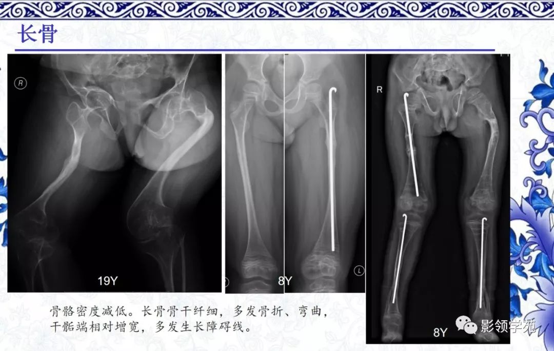 影像PPT - 【PPT】常见骨软骨发育异常的X线表现-49 影像PPT - 【PPT】常见骨软骨发育异常的X线表现-49