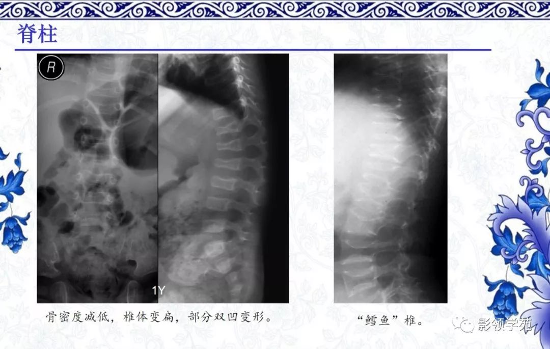 影像PPT - 【PPT】常见骨软骨发育异常的X线表现-50 影像PPT - 【PPT】常见骨软骨发育异常的X线表现-50