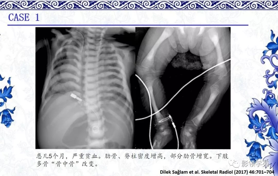 影像PPT - 【PPT】常见骨软骨发育异常的X线表现-53 影像PPT - 【PPT】常见骨软骨发育异常的X线表现-53