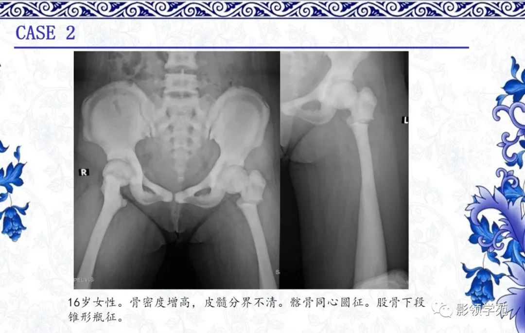 影像PPT - 【PPT】常见骨软骨发育异常的X线表现-54 影像PPT - 【PPT】常见骨软骨发育异常的X线表现-54