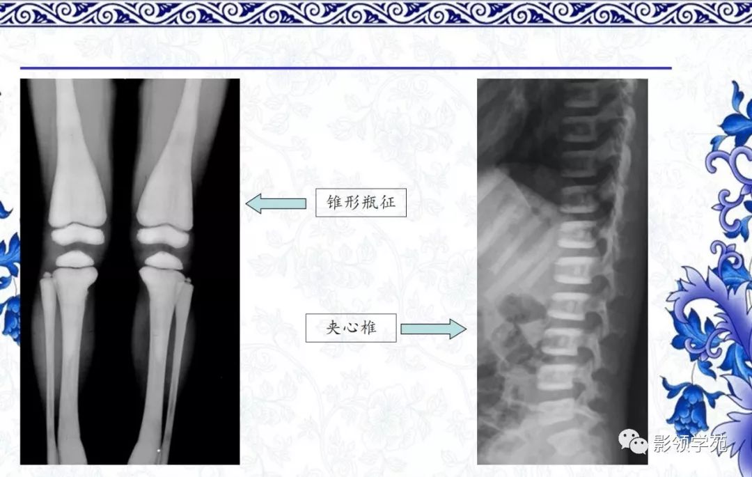 影像PPT - 【PPT】常见骨软骨发育异常的X线表现-55 影像PPT - 【PPT】常见骨软骨发育异常的X线表现-55