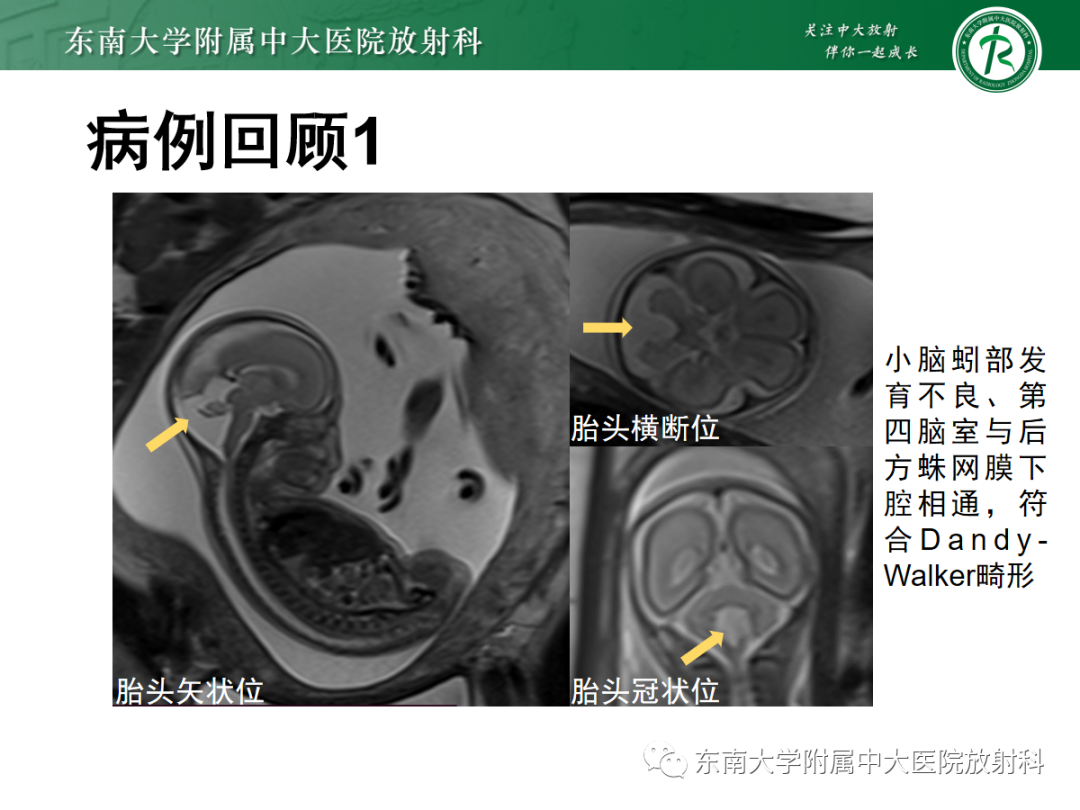 影像PPT - 【PPT】胎儿MRI扫描与常见疾病-3