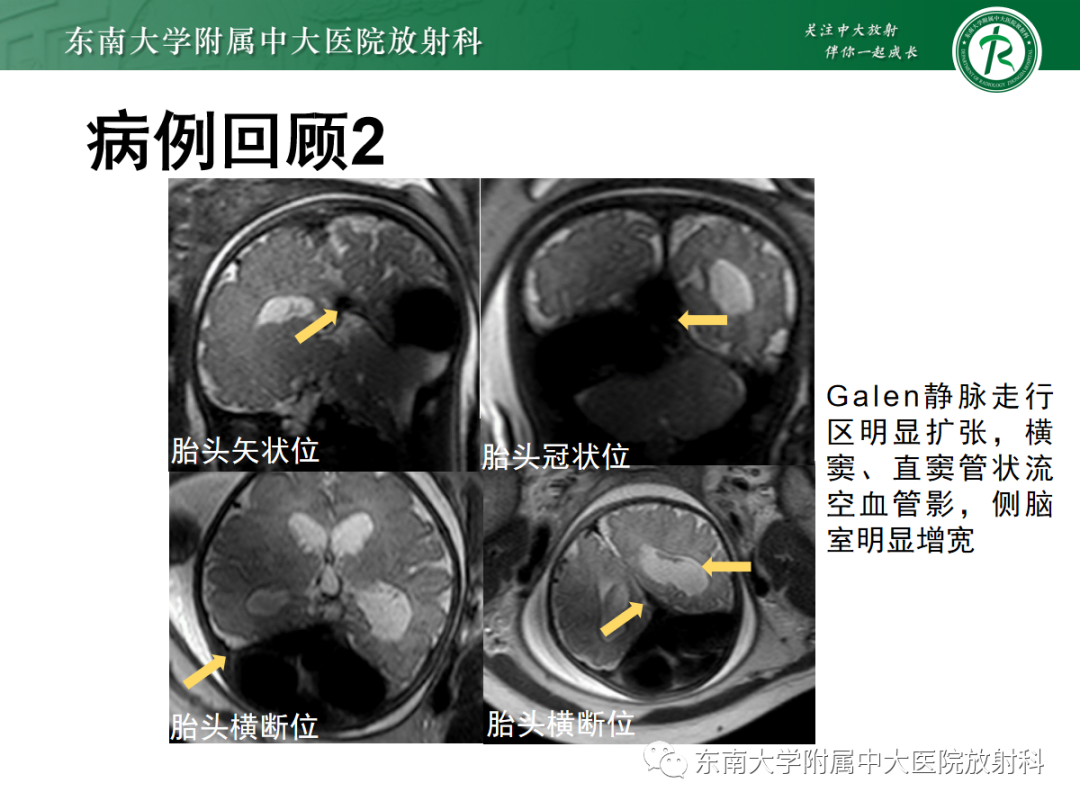 影像PPT - 【PPT】胎儿MRI扫描与常见疾病-4