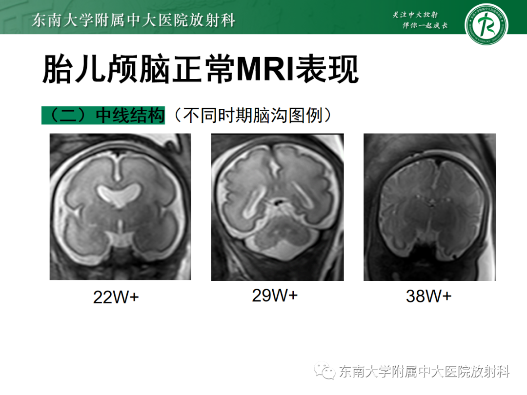 影像PPT - 【PPT】胎儿MRI扫描与常见疾病-19