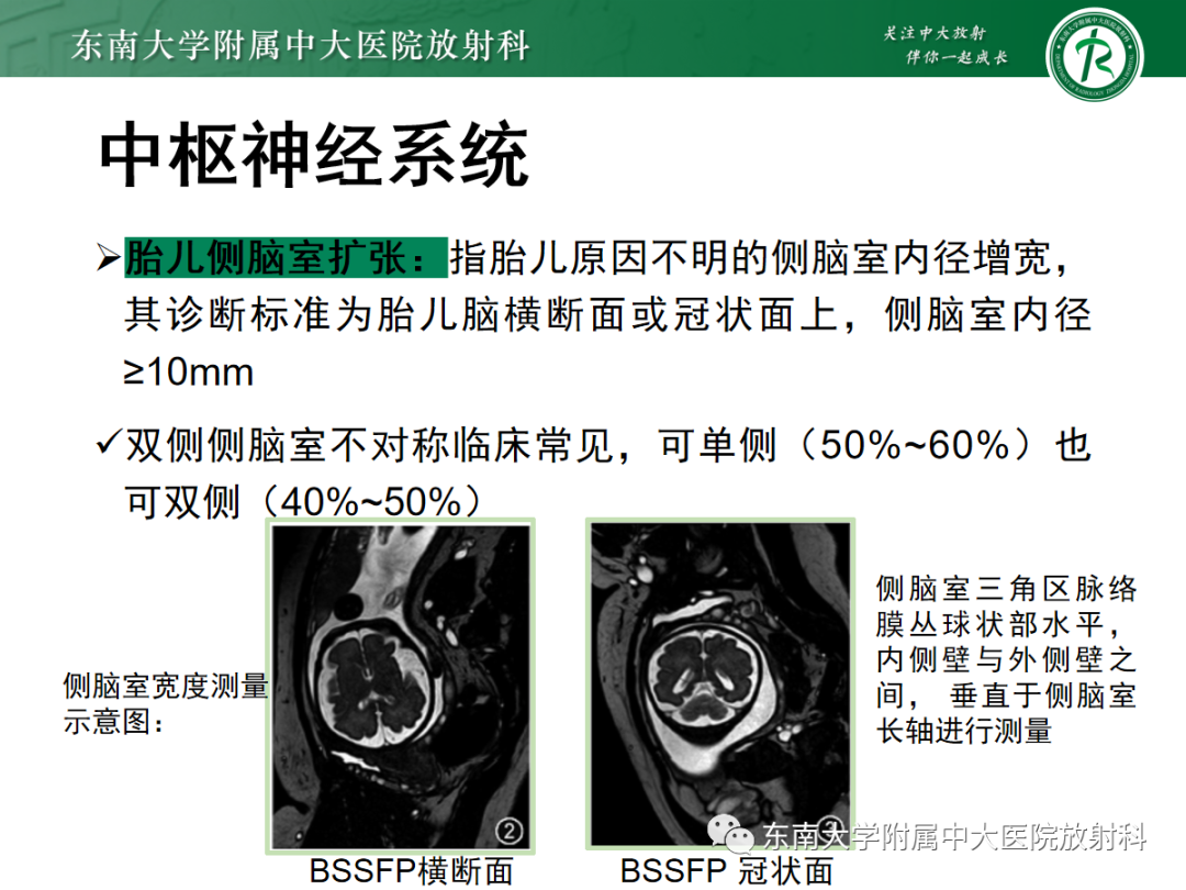 影像PPT - 【PPT】胎儿MRI扫描与常见疾病-24
