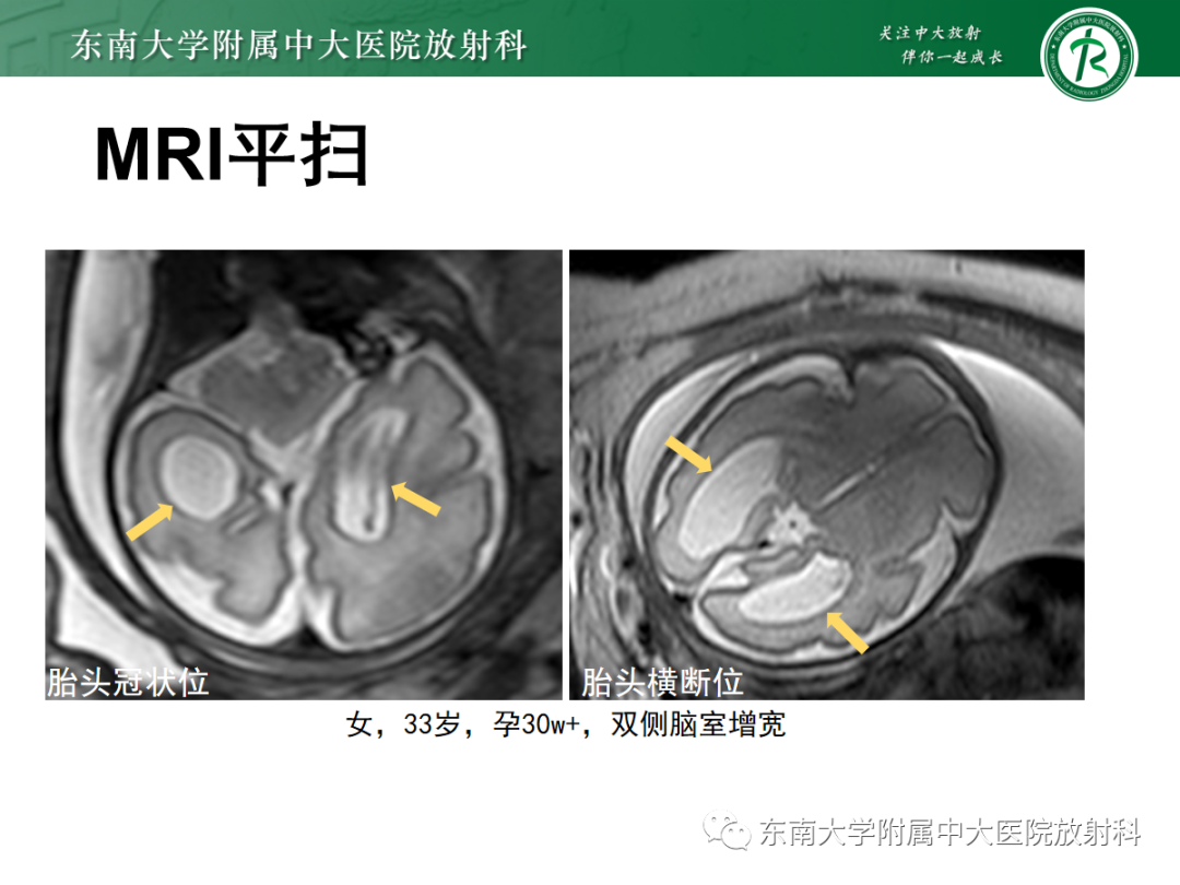影像PPT - 【PPT】胎儿MRI扫描与常见疾病-26