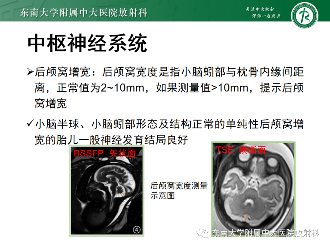 影像PPT - 【PPT】胎儿MRI扫描与常见疾病-27