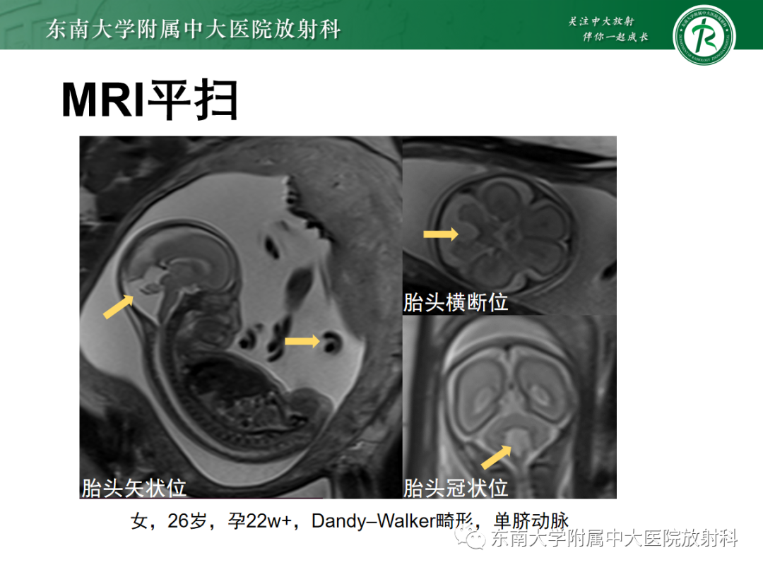 影像PPT - 【PPT】胎儿MRI扫描与常见疾病-29