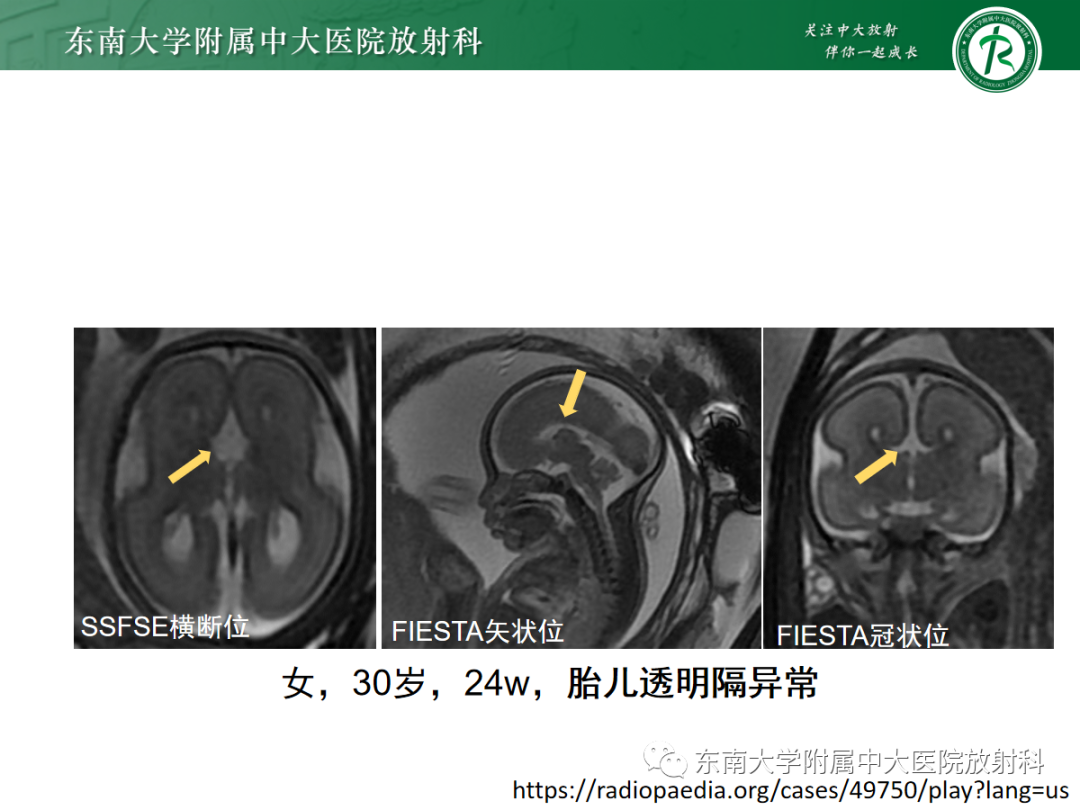 影像PPT - 【PPT】胎儿MRI扫描与常见疾病-32