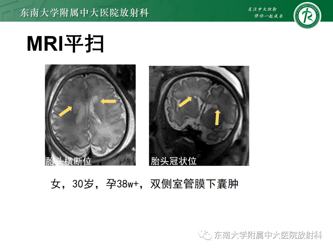 影像PPT - 【PPT】胎儿MRI扫描与常见疾病-35