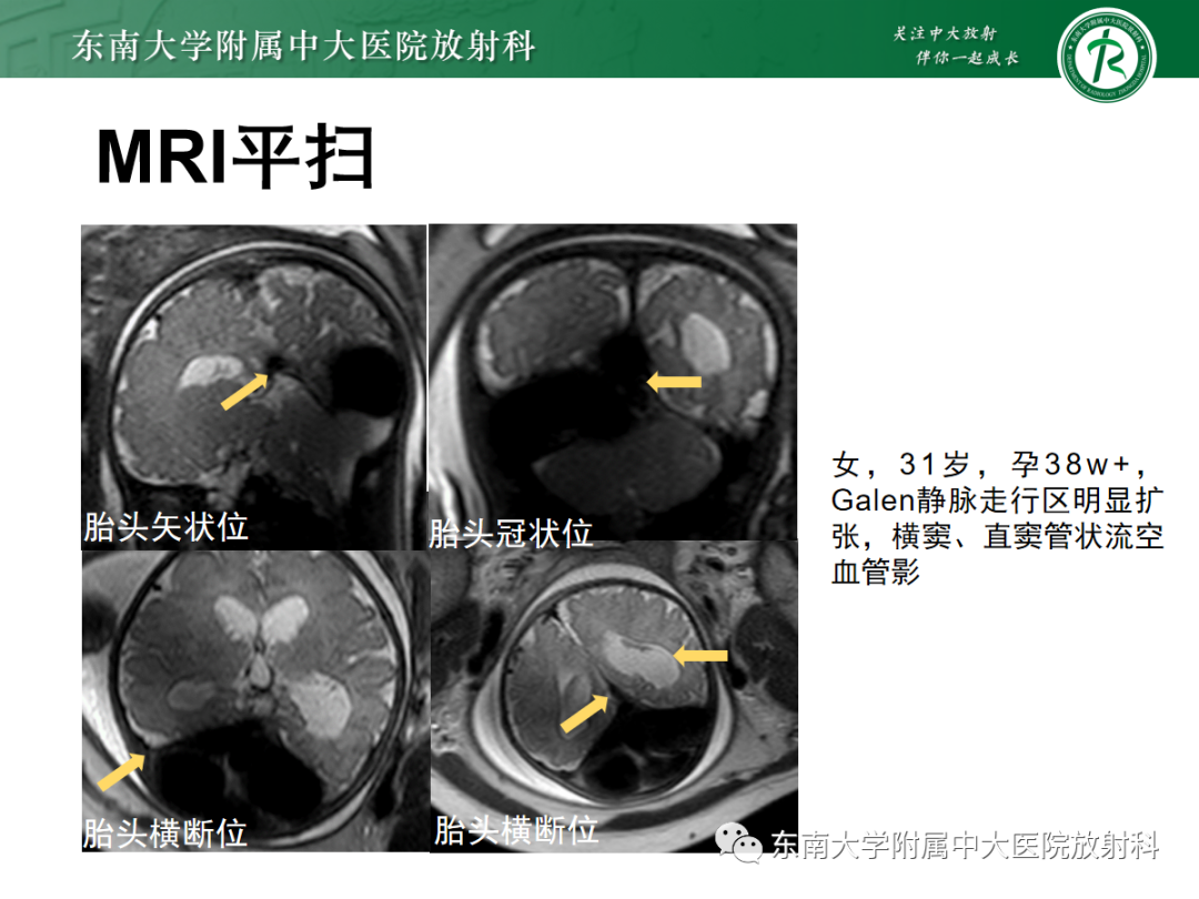 影像PPT - 【PPT】胎儿MRI扫描与常见疾病-37