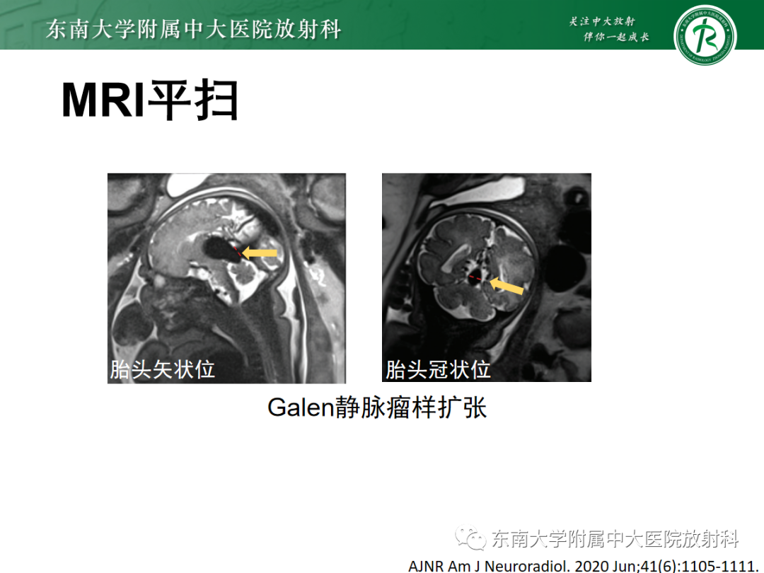 影像PPT - 【PPT】胎儿MRI扫描与常见疾病-38