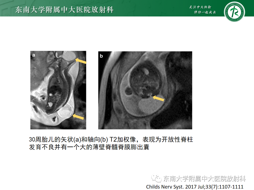 影像PPT - 【PPT】胎儿MRI扫描与常见疾病-45