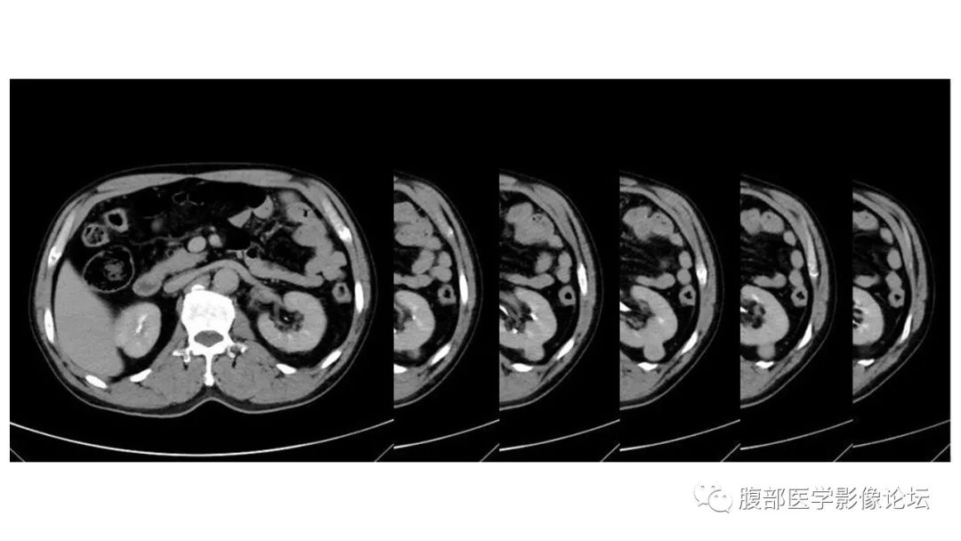 影像PPT - 【病例】肾脏乳头状肾癌1例CT及MR-5 影像PPT - 【病例】肾脏乳头状肾癌1例CT及MR-5