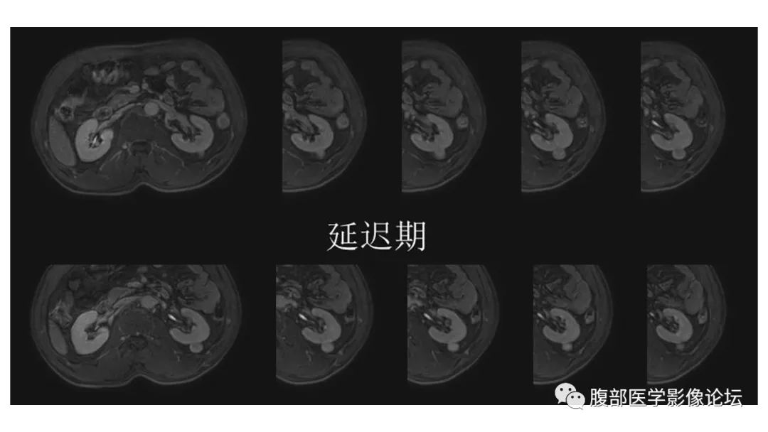 影像PPT - 【病例】肾脏乳头状肾癌1例CT及MR-13 影像PPT - 【病例】肾脏乳头状肾癌1例CT及MR-13