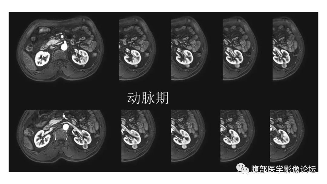 影像PPT - 【病例】肾脏乳头状肾癌1例CT及MR-11 影像PPT - 【病例】肾脏乳头状肾癌1例CT及MR-11