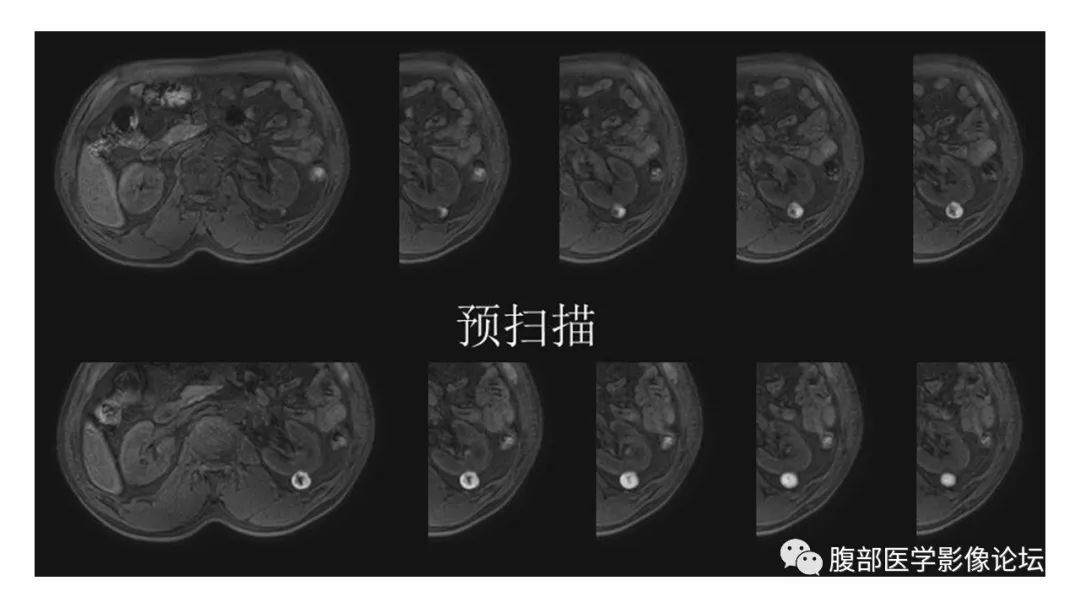 影像PPT - 【病例】肾脏乳头状肾癌1例CT及MR-10 影像PPT - 【病例】肾脏乳头状肾癌1例CT及MR-10