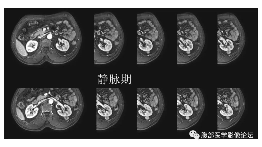 影像PPT - 【病例】肾脏乳头状肾癌1例CT及MR-12 影像PPT - 【病例】肾脏乳头状肾癌1例CT及MR-12
