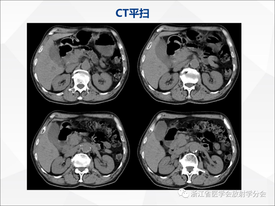 影像PPT - 【病例】异物穿孔伴胰腺炎1例CT及MR影像-4