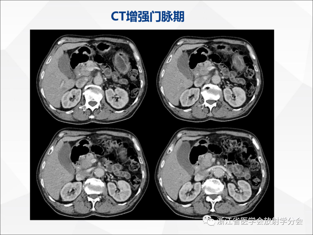 影像PPT - 【病例】异物穿孔伴胰腺炎1例CT及MR影像-6