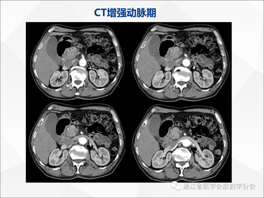 影像PPT - 【病例】异物穿孔伴胰腺炎1例CT及MR影像-5