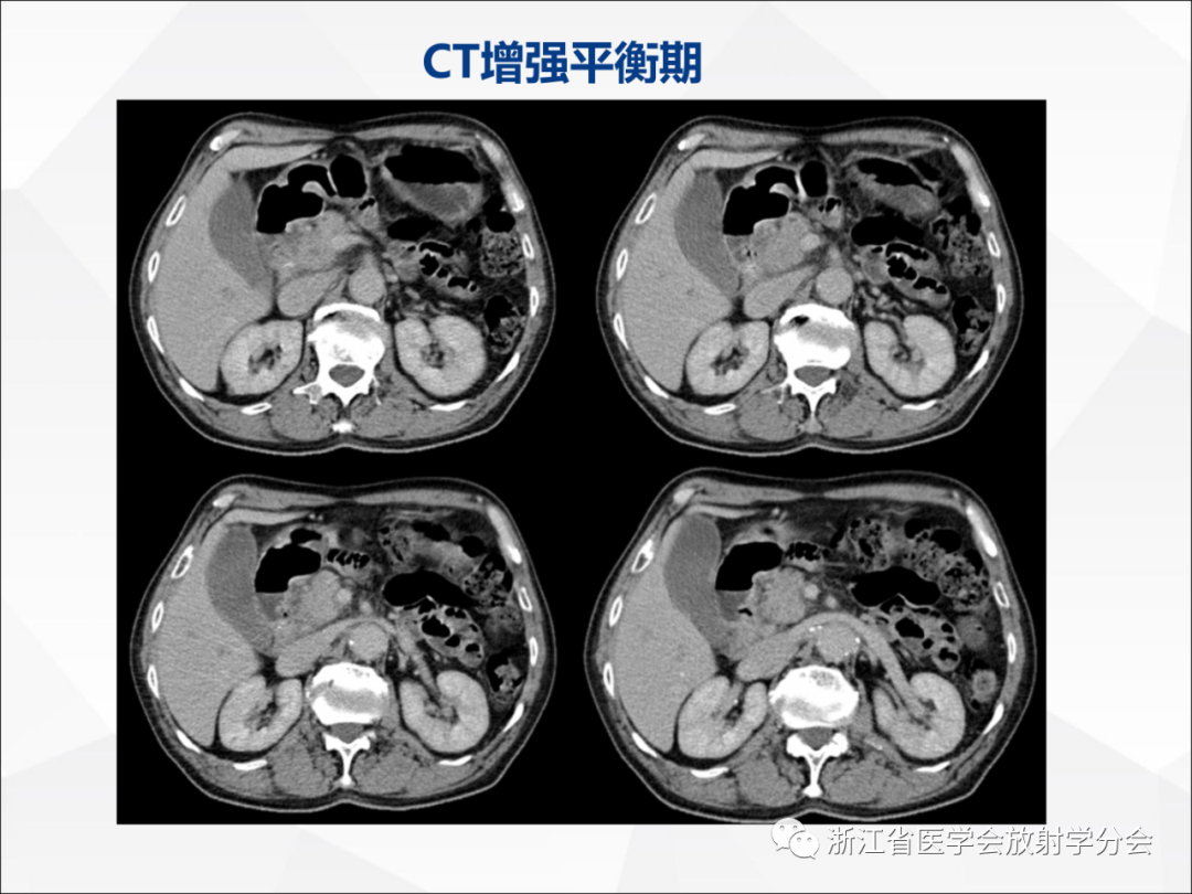 影像PPT - 【病例】异物穿孔伴胰腺炎1例CT及MR影像-7