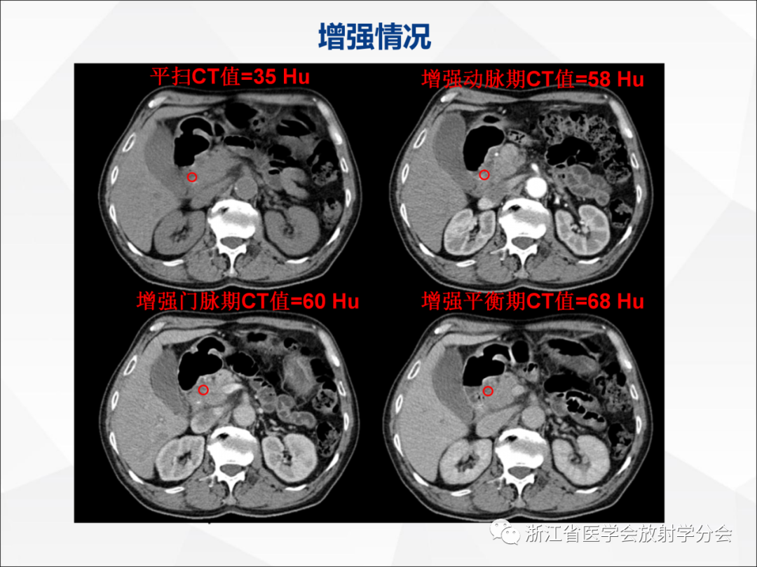 影像PPT - 【病例】异物穿孔伴胰腺炎1例CT及MR影像-8