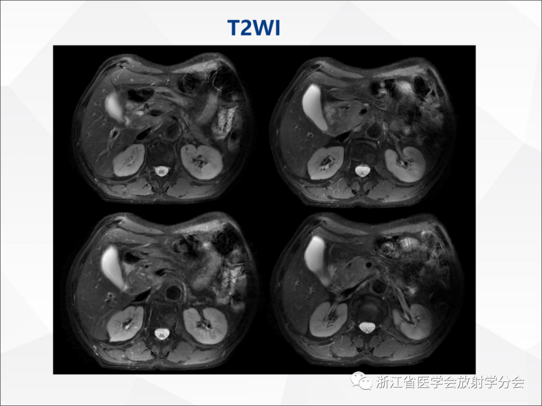 影像PPT - 【病例】异物穿孔伴胰腺炎1例CT及MR影像-10