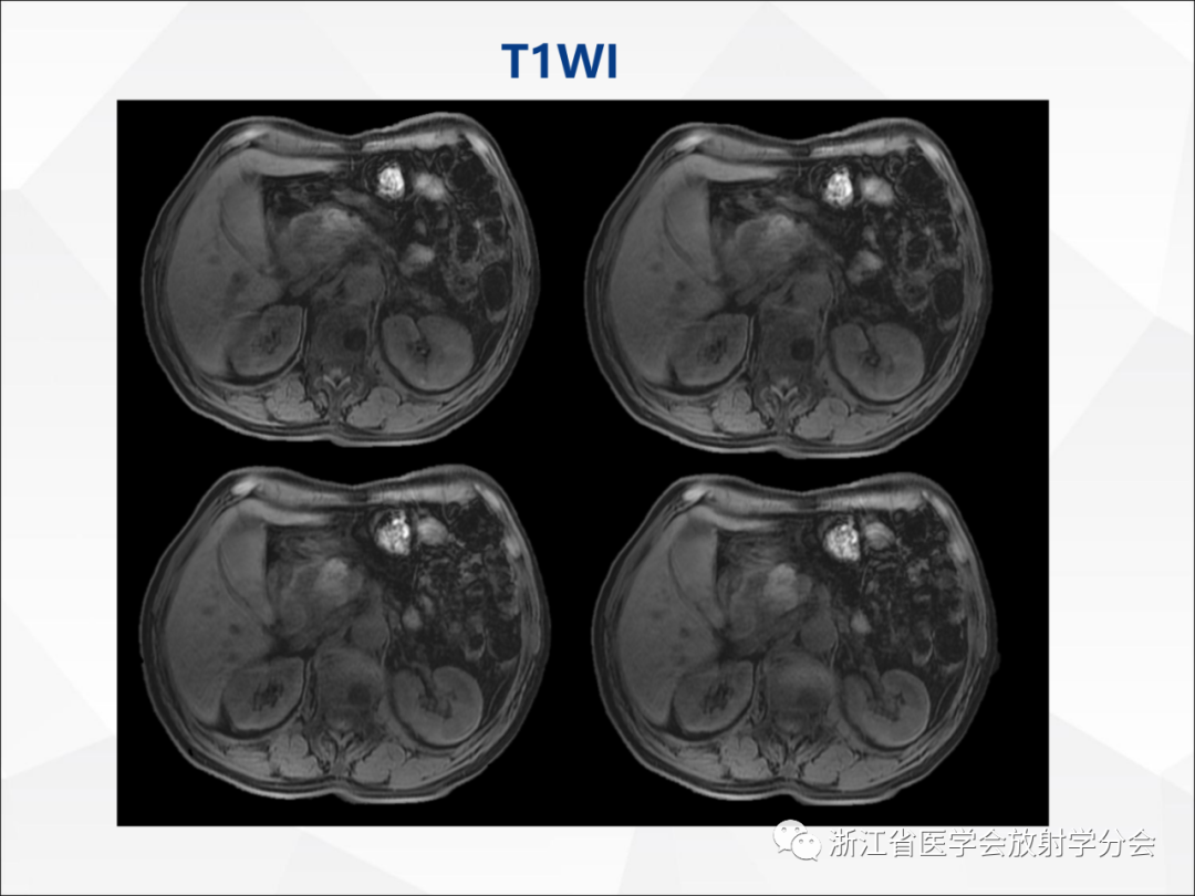 影像PPT - 【病例】异物穿孔伴胰腺炎1例CT及MR影像-9