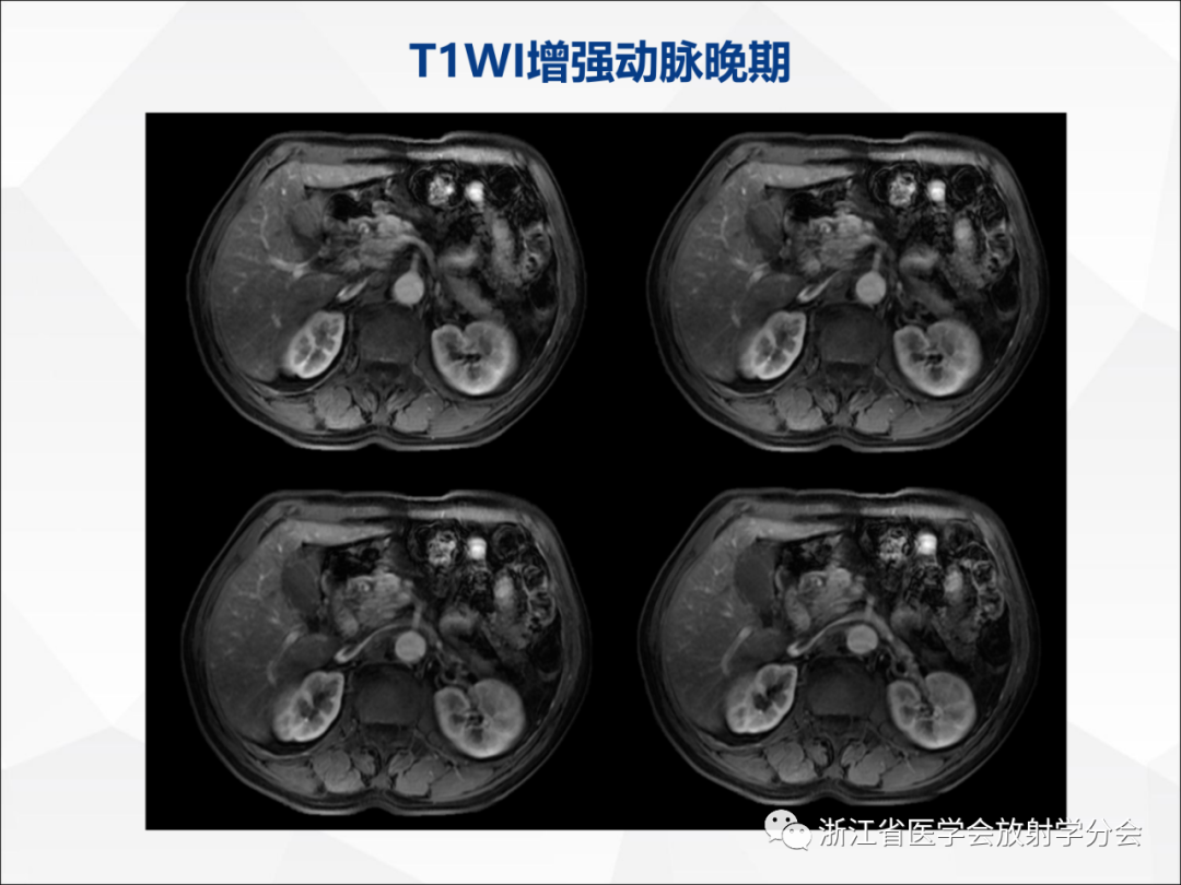 影像PPT - 【病例】异物穿孔伴胰腺炎1例CT及MR影像-11