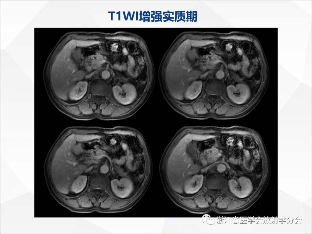 影像PPT - 【病例】异物穿孔伴胰腺炎1例CT及MR影像-12