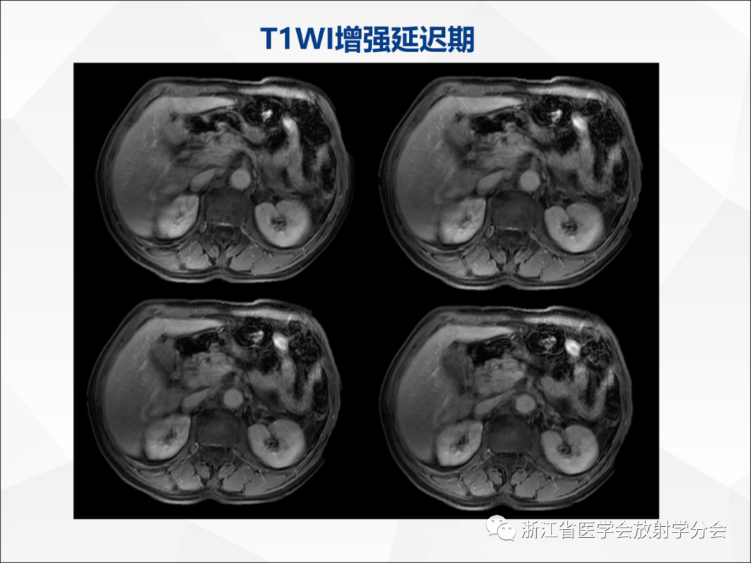 影像PPT - 【病例】异物穿孔伴胰腺炎1例CT及MR影像-13
