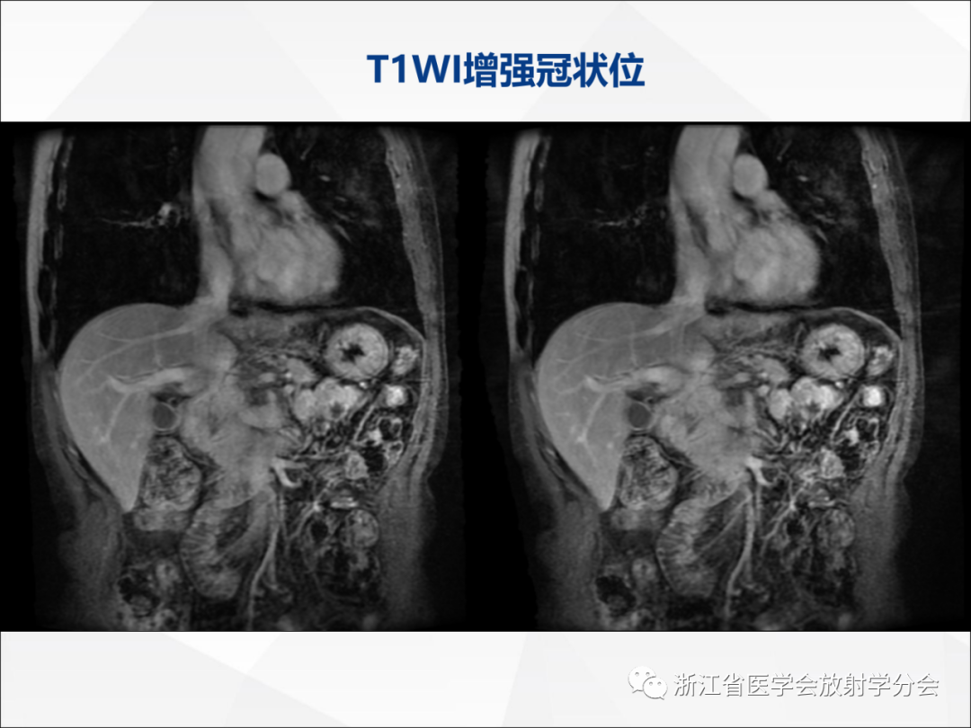 影像PPT - 【病例】异物穿孔伴胰腺炎1例CT及MR影像-14