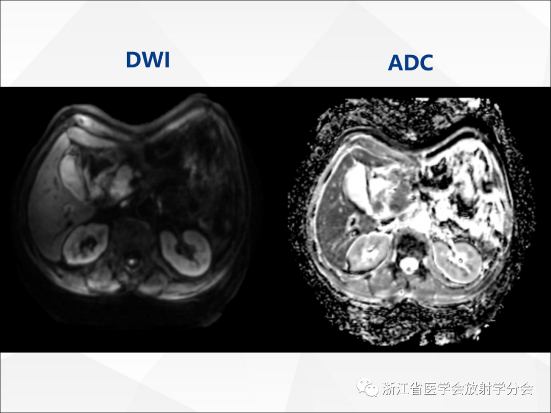 影像PPT - 【病例】异物穿孔伴胰腺炎1例CT及MR影像-15