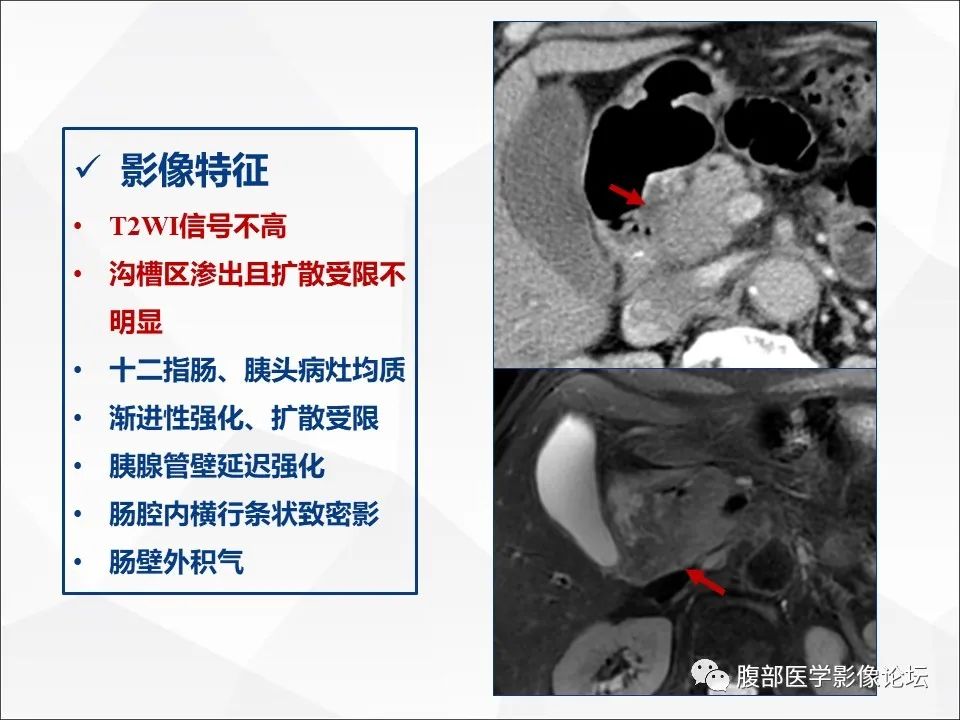 影像PPT - 【病例】异物穿孔伴胰腺炎1例CT及MR影像-19