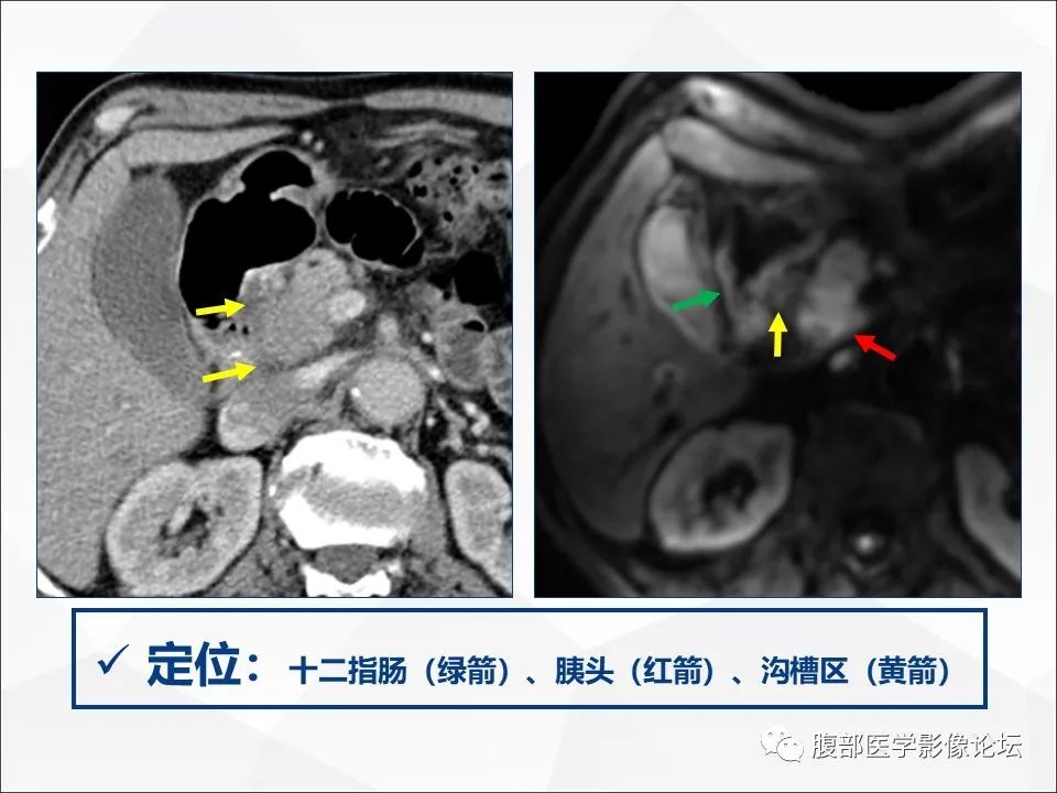 影像PPT - 【病例】异物穿孔伴胰腺炎1例CT及MR影像-18