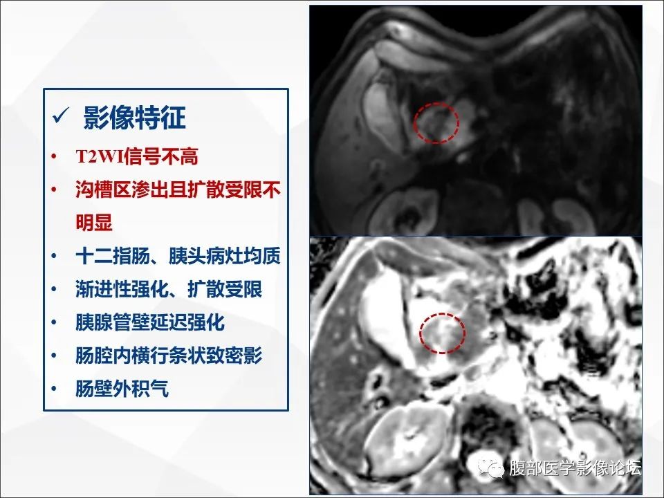 影像PPT - 【病例】异物穿孔伴胰腺炎1例CT及MR影像-20