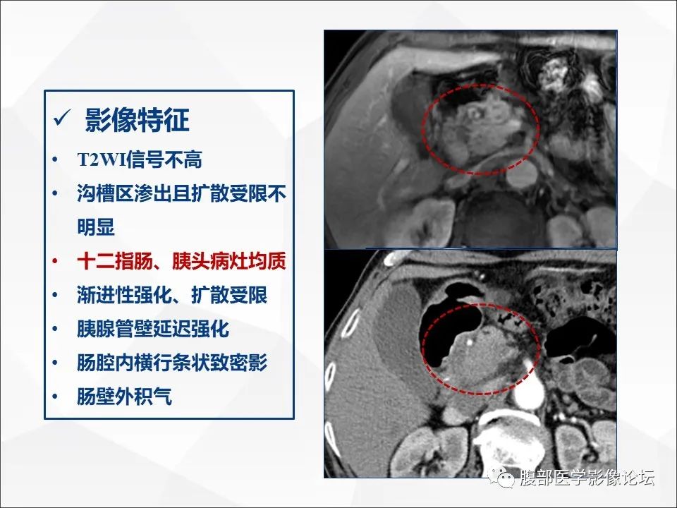 影像PPT - 【病例】异物穿孔伴胰腺炎1例CT及MR影像-21