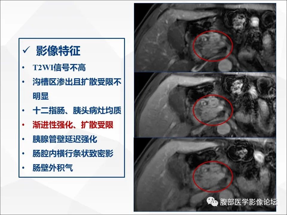 影像PPT - 【病例】异物穿孔伴胰腺炎1例CT及MR影像-23