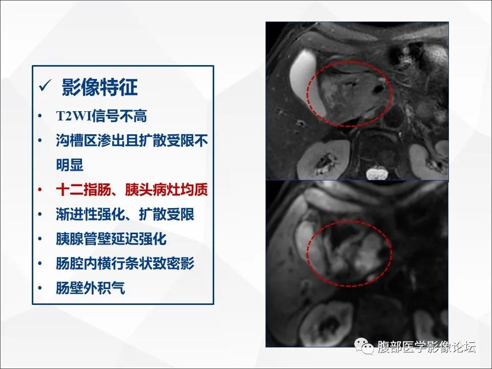 影像PPT - 【病例】异物穿孔伴胰腺炎1例CT及MR影像-22