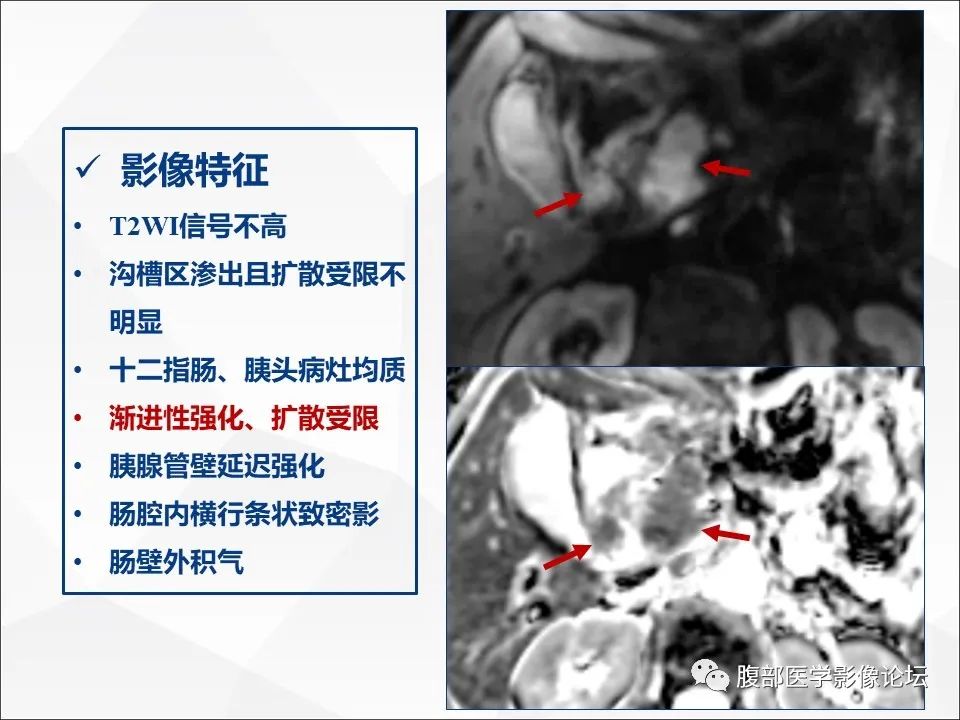 影像PPT - 【病例】异物穿孔伴胰腺炎1例CT及MR影像-25