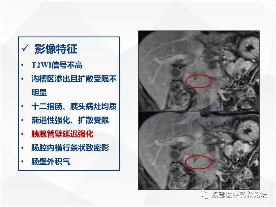 影像PPT - 【病例】异物穿孔伴胰腺炎1例CT及MR影像-26