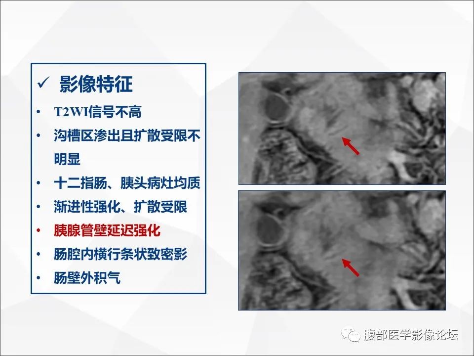 影像PPT - 【病例】异物穿孔伴胰腺炎1例CT及MR影像-27