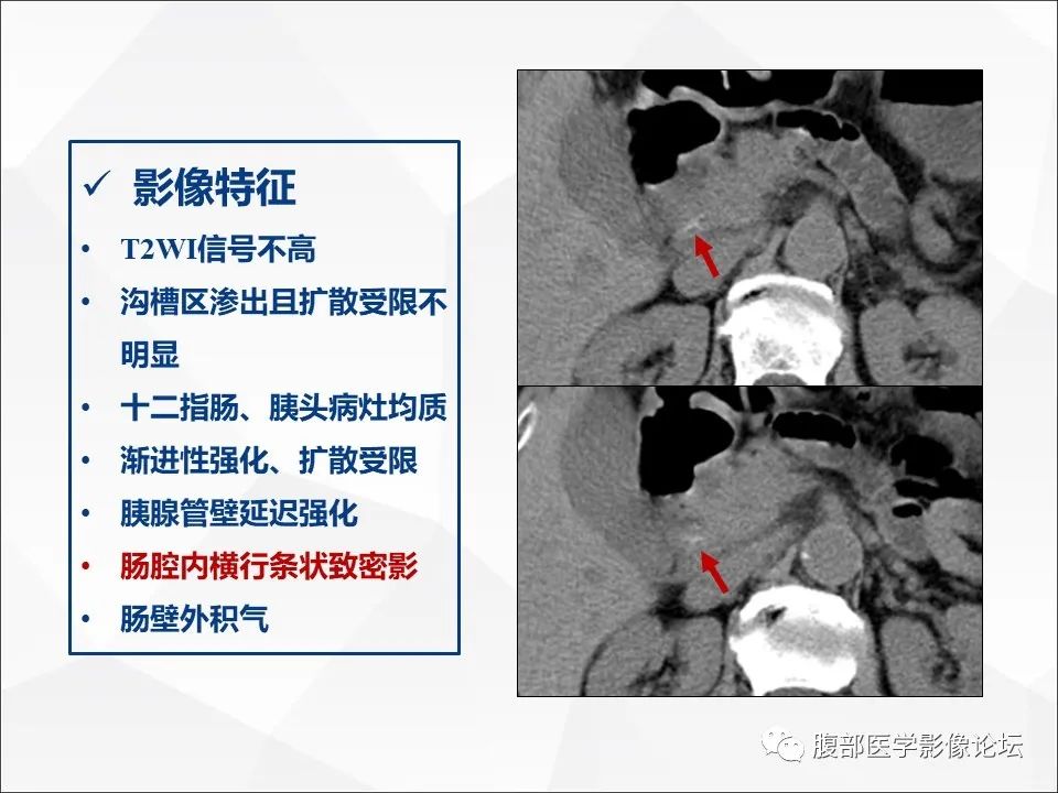 影像PPT - 【病例】异物穿孔伴胰腺炎1例CT及MR影像-28