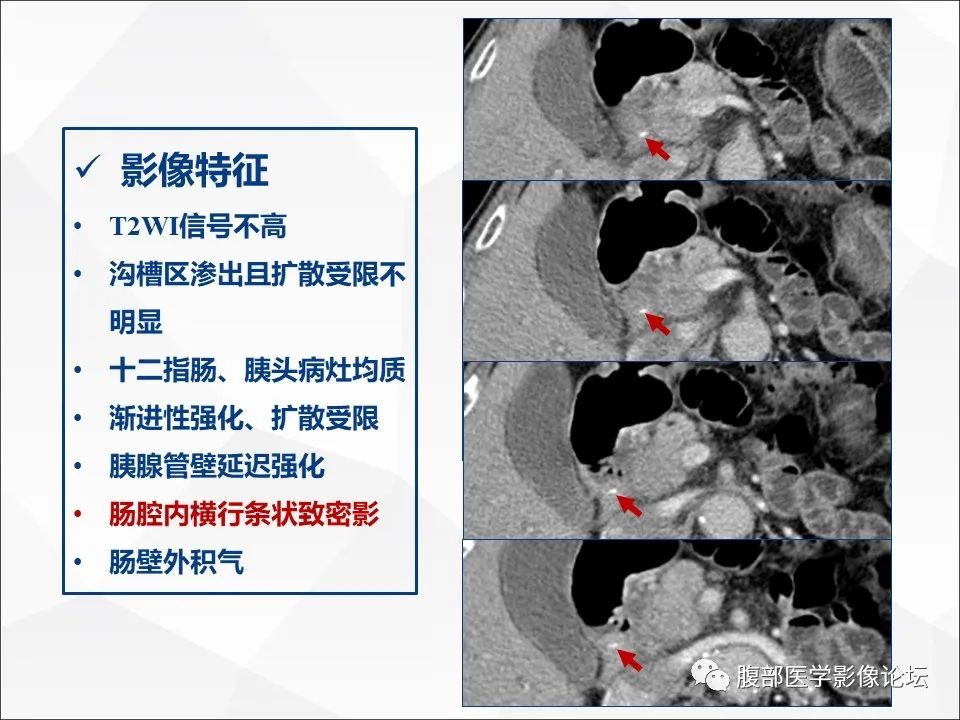 影像PPT - 【病例】异物穿孔伴胰腺炎1例CT及MR影像-29