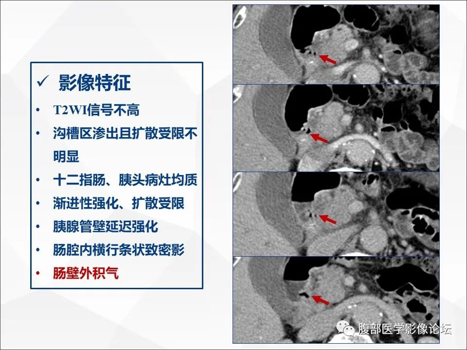 影像PPT - 【病例】异物穿孔伴胰腺炎1例CT及MR影像-30